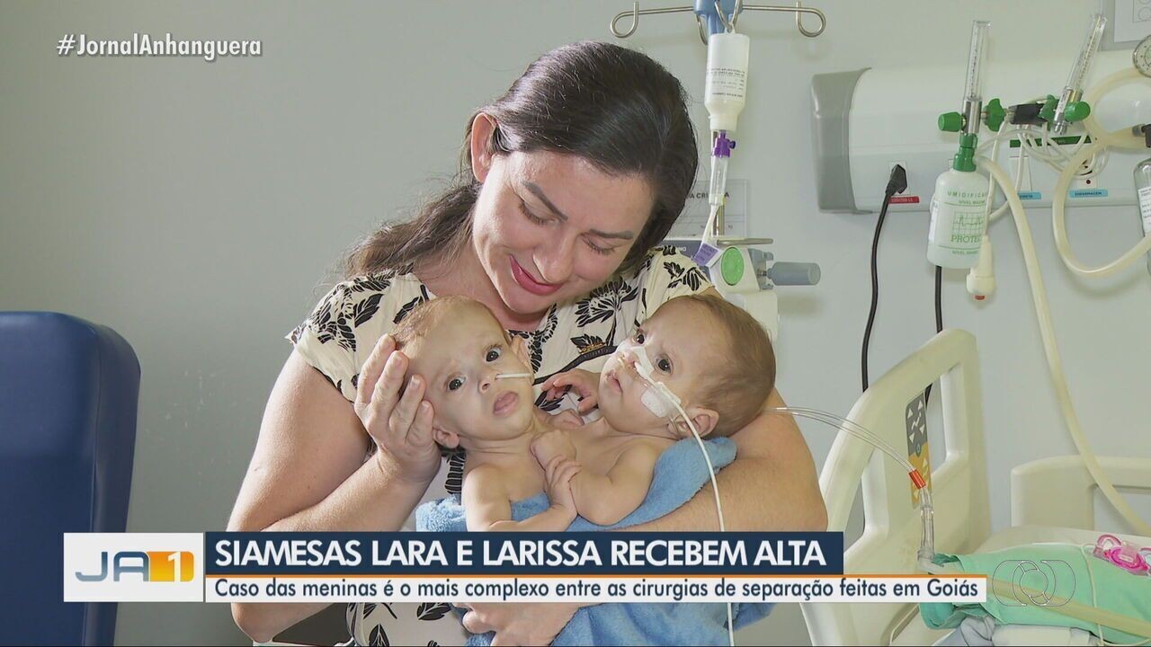 Siamesas que nasceram unidas pelo tórax abdômen e genitália deixam