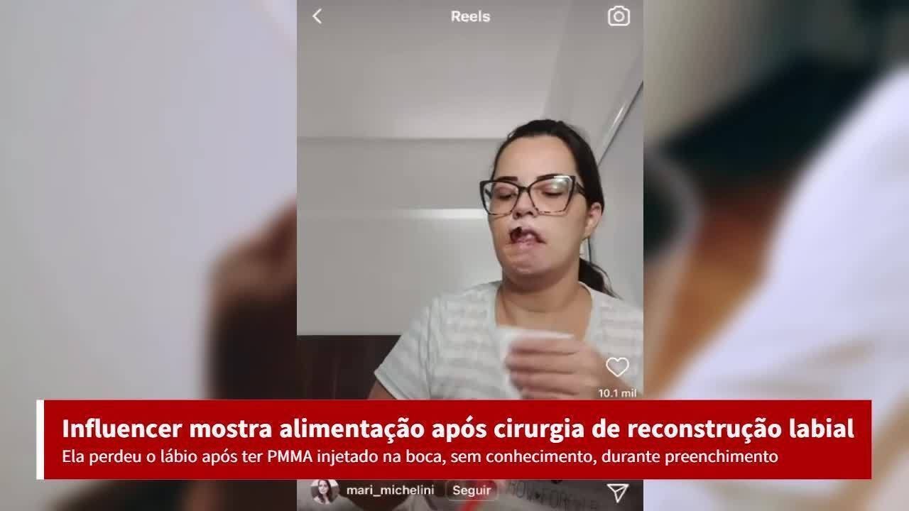 Influencer que perdeu lábio em harmonização PMMA conta como é