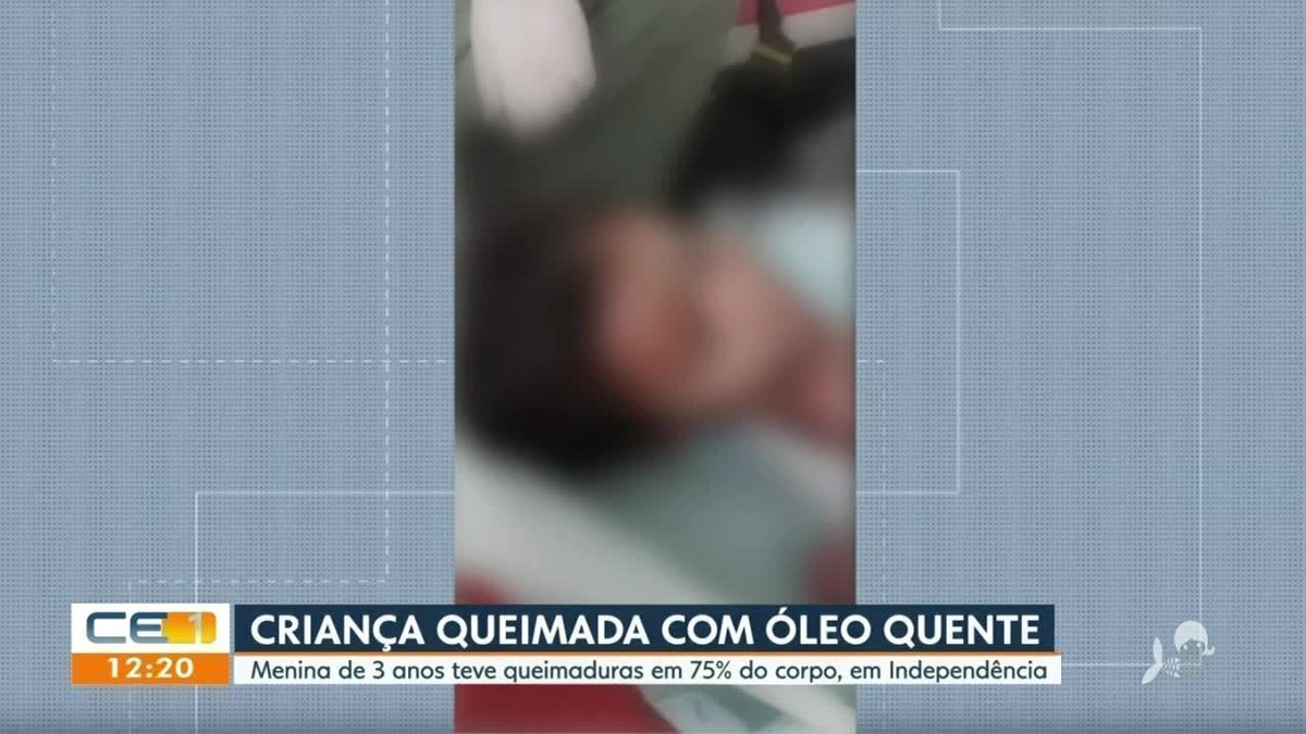 Menina De Anos Cai Em Caldeir O De Leo E Sofre Queimadura Em Do