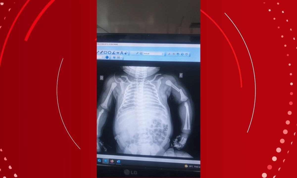 Família denúncia negligência após bebê ter braço quebrado durante parto em maternidade de Salvador