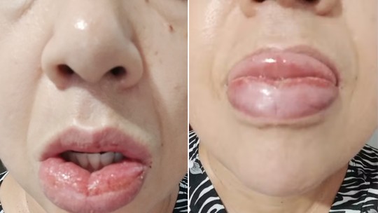 Mais de 1,2 mil pessoas relataram reação à pasta da Colgate; venda segue proibida - Relatos incluem ardência, inchaço e aftas. Produto teve mudança na fórmula em 2024 e marca investiga componentes que possam causar reações.