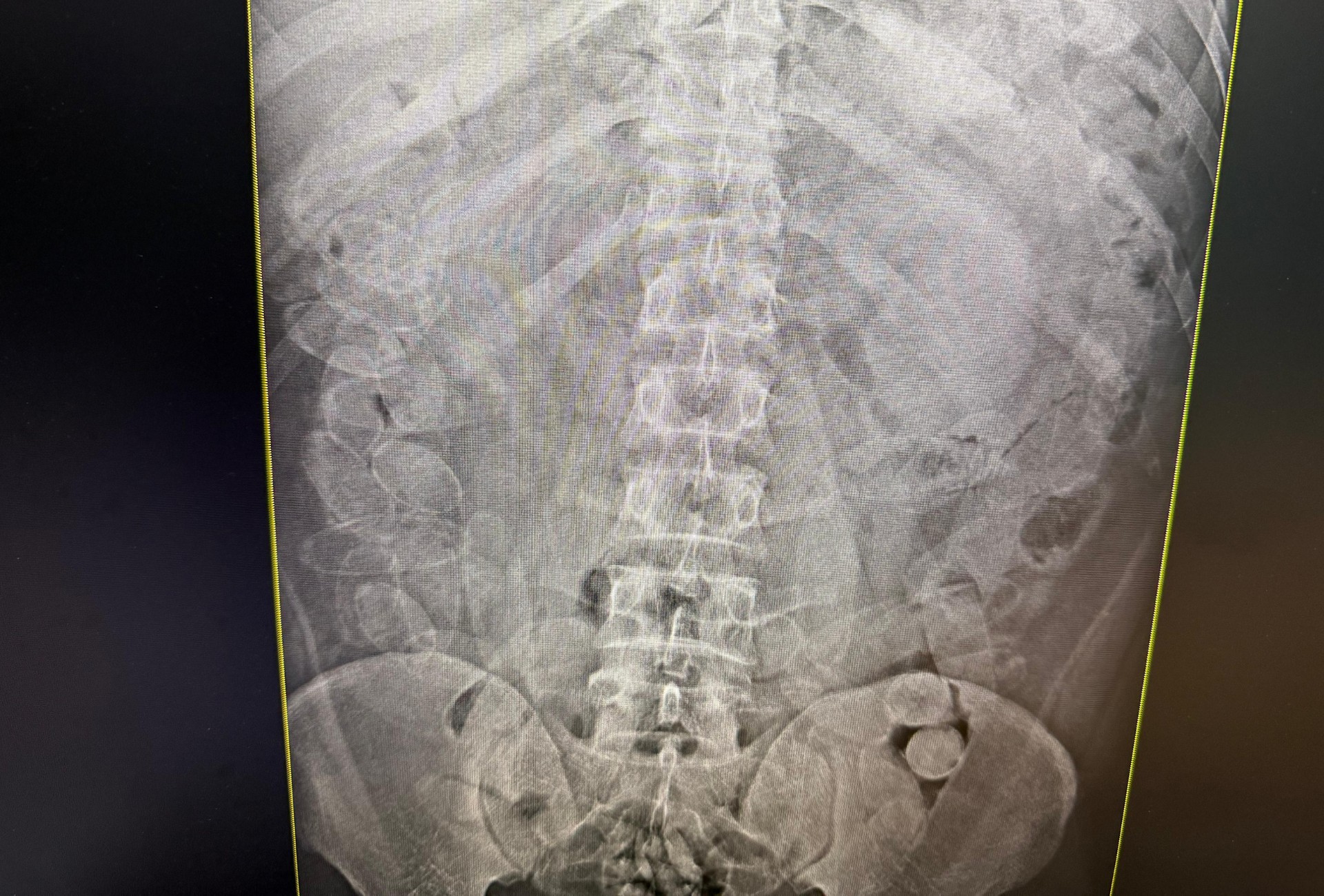 Bolivianos são presos com droga escondida na cueca e no estômago ao tentar entrar no Brasil por Corumbá