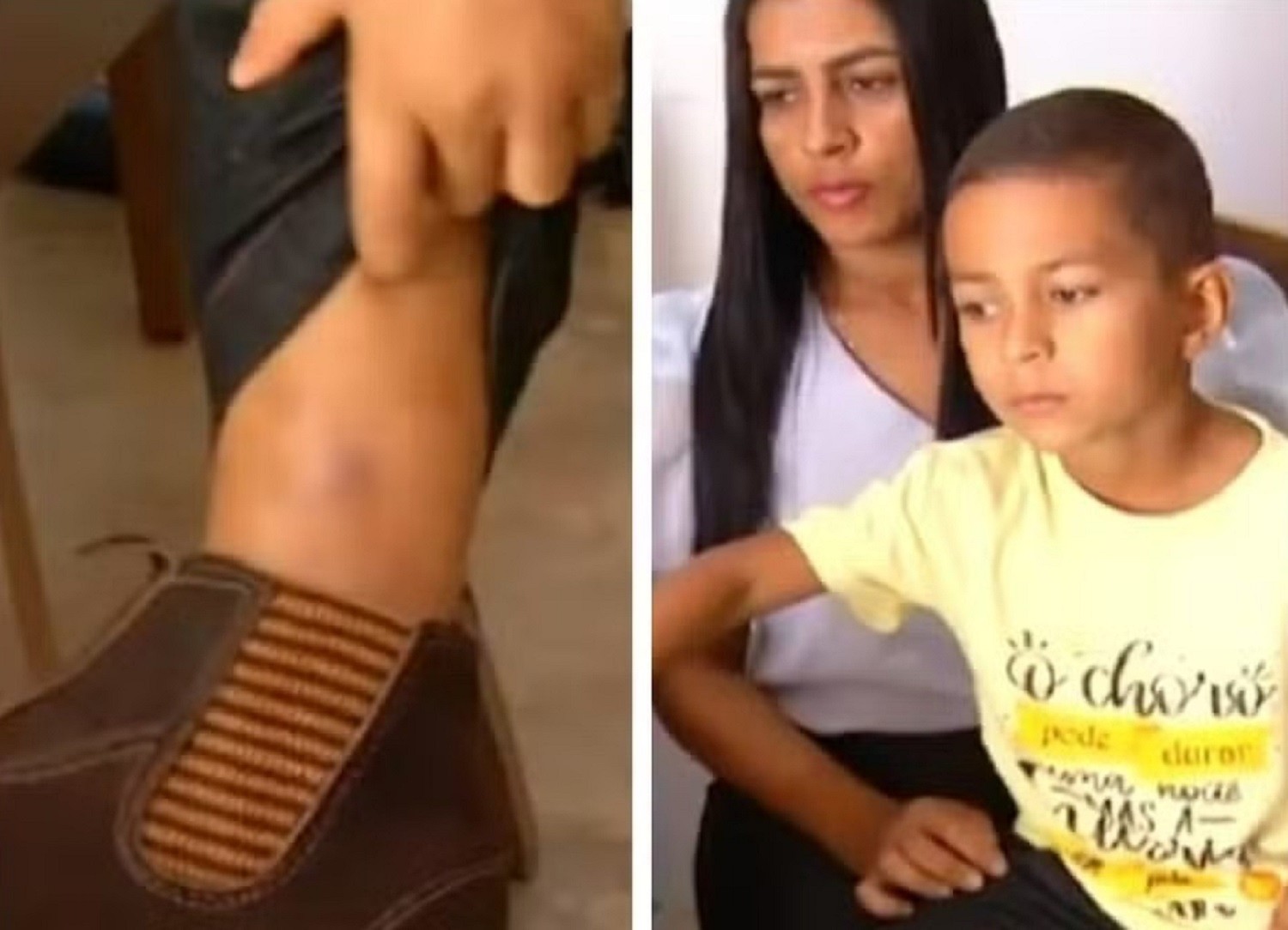 Menino que sobreviveu a picada de jararaca foi surpreendido por cobra: 'Estava fechando o portão'