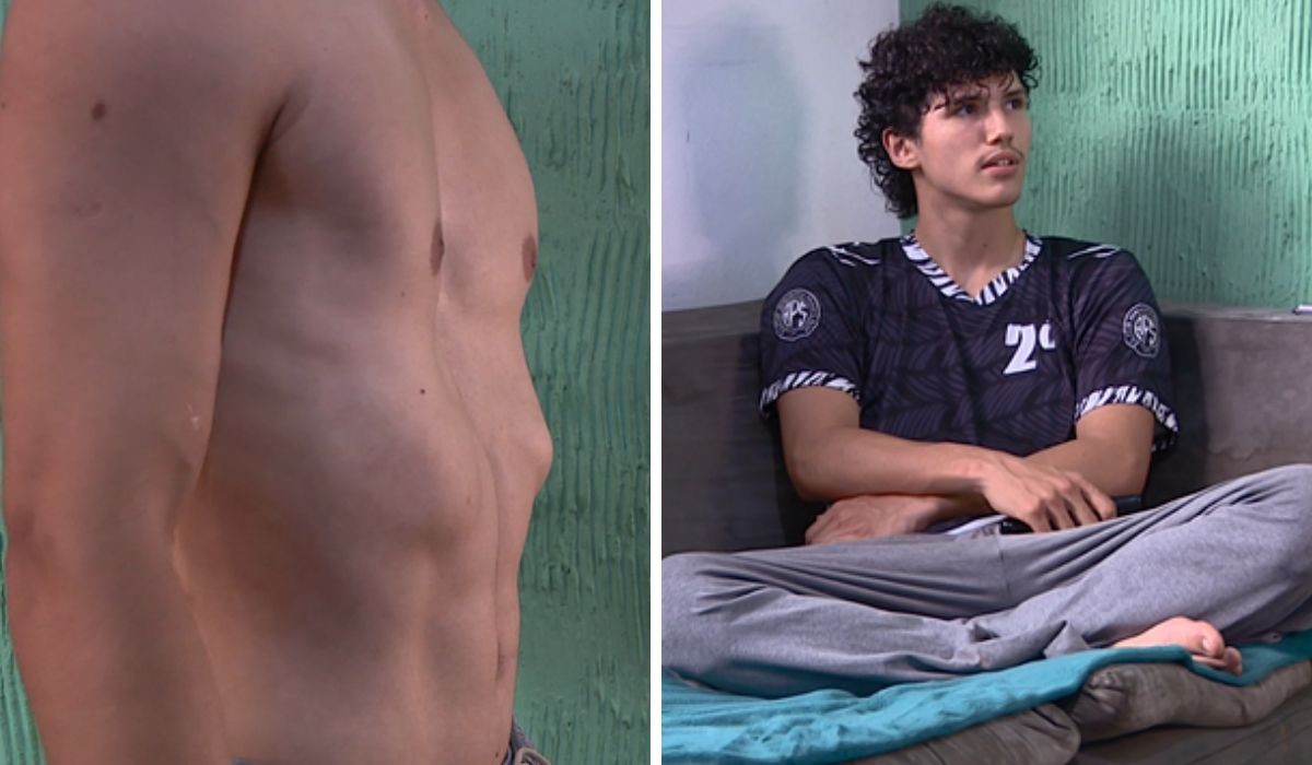 Estudante lamenta demora por cirurgia para corrigir ossos do peito: 'Minha vida é bem parada'