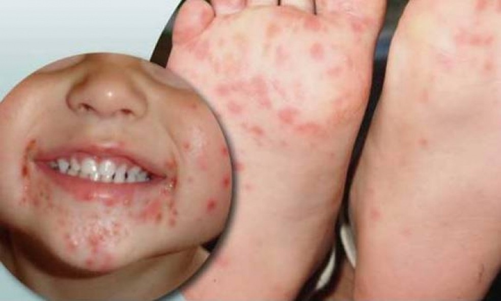 Entenda os sintomas da doença 'mão-pé-boca'