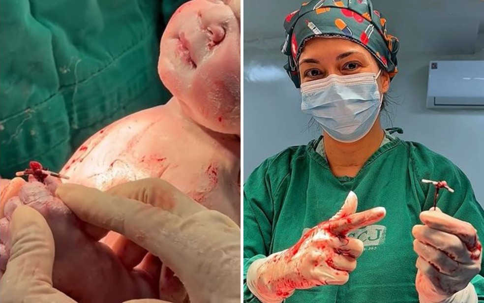 Médica colocou DIU na mão de bebê após parto em Nerópolis, Goiás — Foto: Reprodução/Instagram de Natalia Rodrigues