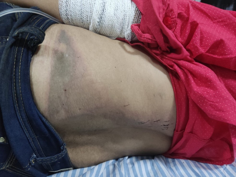 Mulher agredida pelo marido teve costelas e clavícula quebradas em Mara Rosa, Goiás — Foto: Divulgação/PC