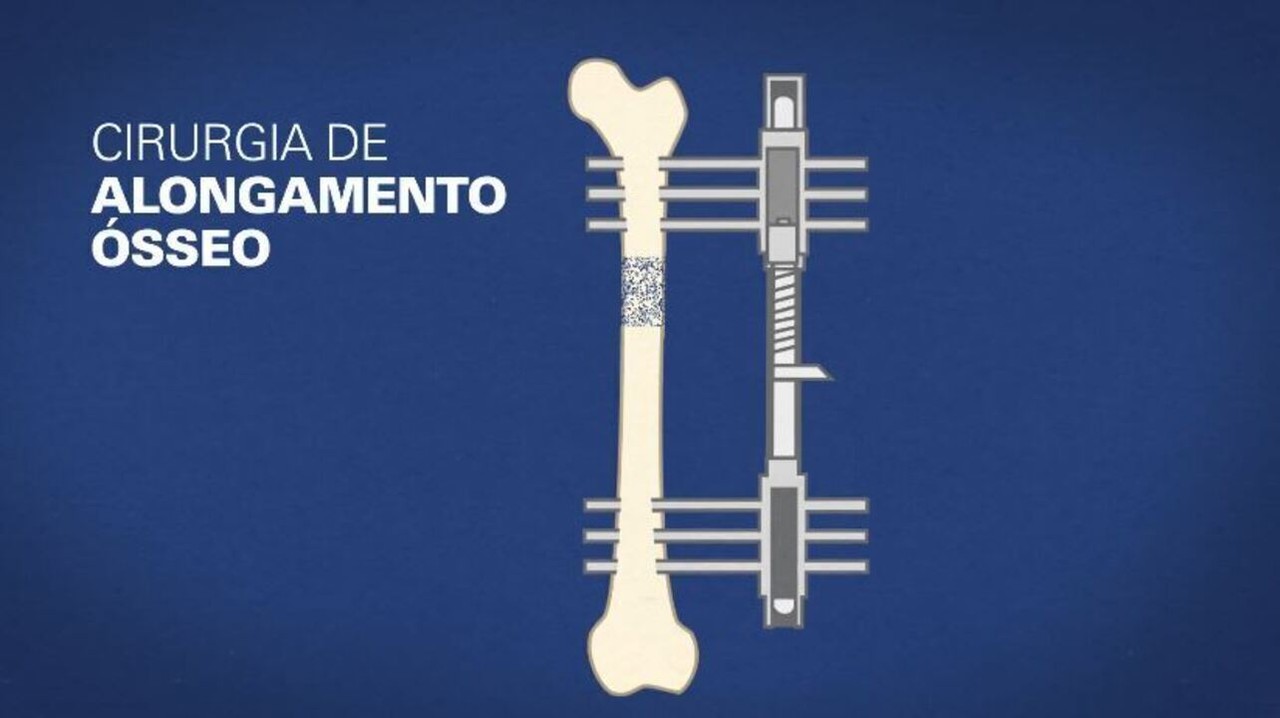 Alongamento ósseo: entenda cirurgia para ganhar centímetros de altura ...