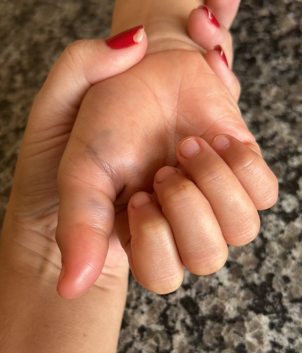 uma das vtimas teve o dedo quebrado aps ser agredida pela madrasta, segundo a polcia  Foto: Arquivo pessoal