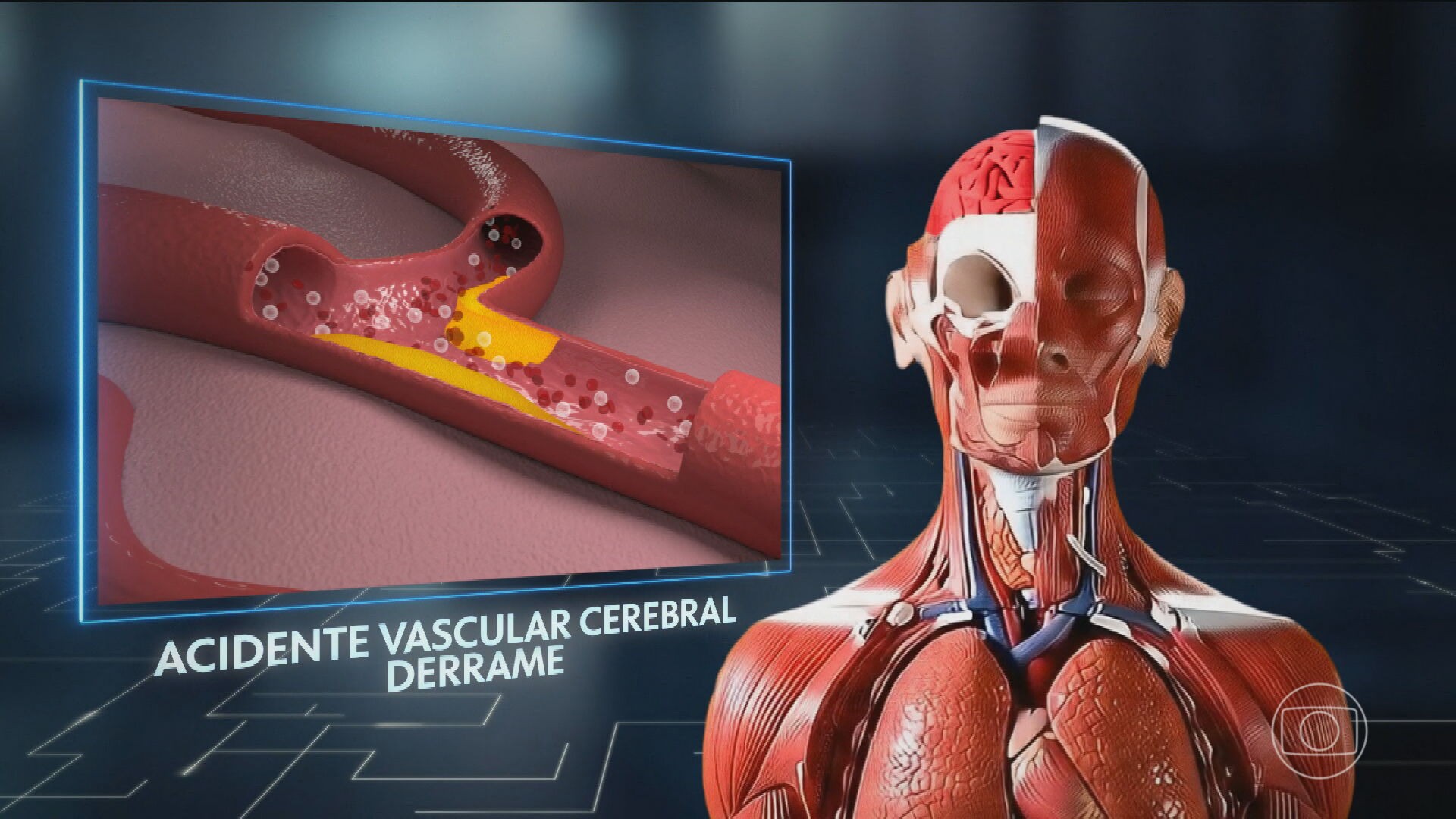 Aumenta número de jovens brasileiros que tratam sequelas de AVC; médicos alertam para fatores de risco relacionados ao estilo de vida