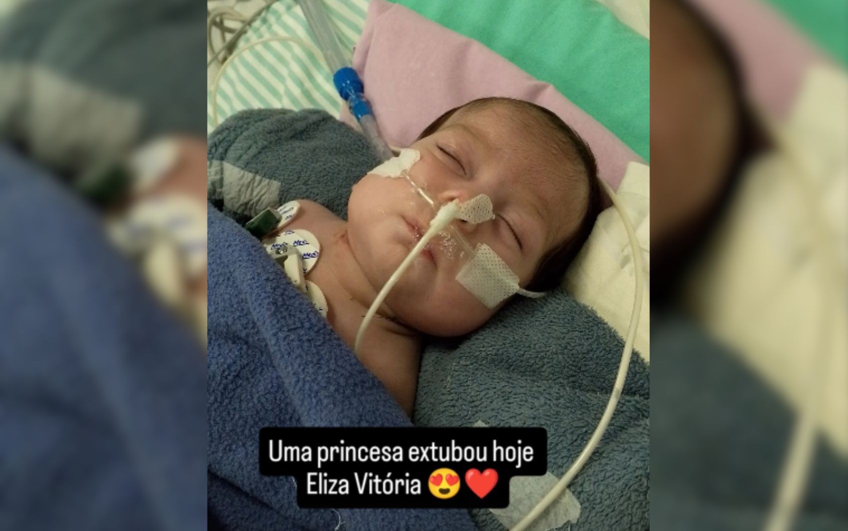 Gêmea de Manaus que passou por cirurgia de separação em Goiânia é extubada, diz família