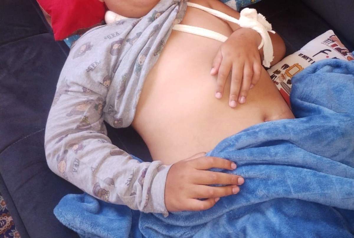 Família denuncia negligência após filho cair de cadeira de rodas e fraturar o braço na Apae em Piraju