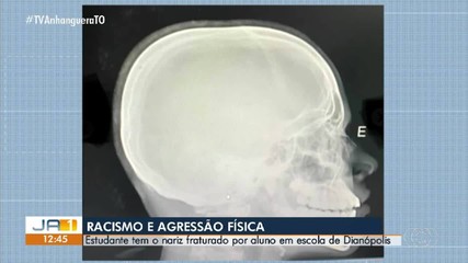 Estudante sofre fratura no nariz após levar soco de colega dentro de escola em Dianópolis