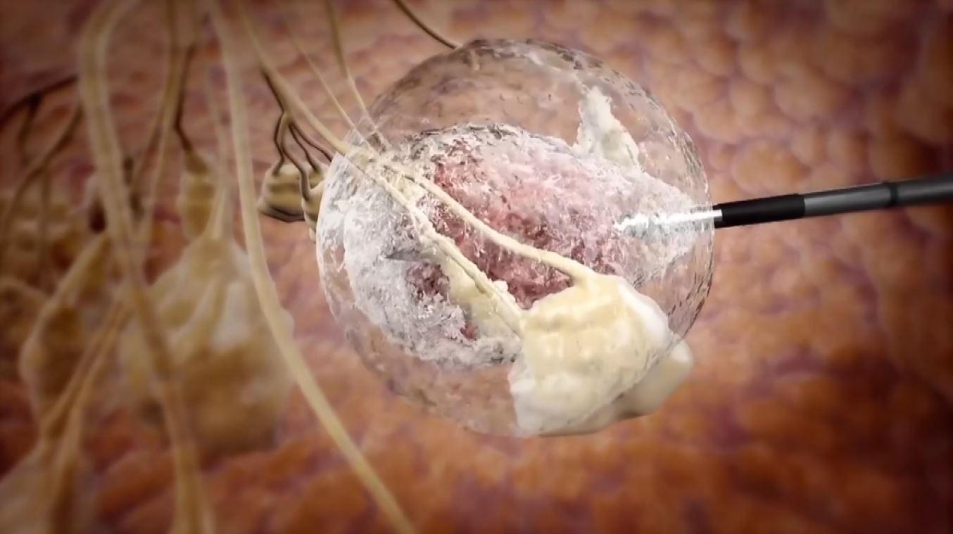 Crioablação: Nova técnica em teste para tratar o câncer de mama usa congelamento; entenda