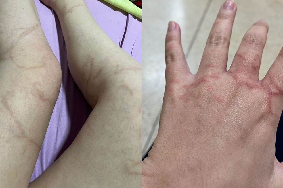 Dois meses após o acidente, Brenda ainda está se recuperando — Foto: Arquivo pessoal