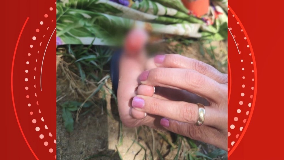 Banhistas mostram ferimentos e suspeitam de ataque de piranhas em Lagoa no Espírito Santo — Foto: Reprodução/TV Gazeta