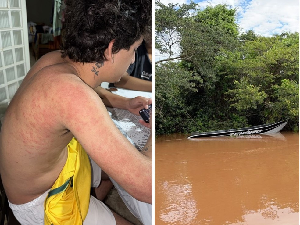 Jovem com marcas no corpo por conta de alergia e barco que afundou no rio. — Foto: Arquivo Pessoal.