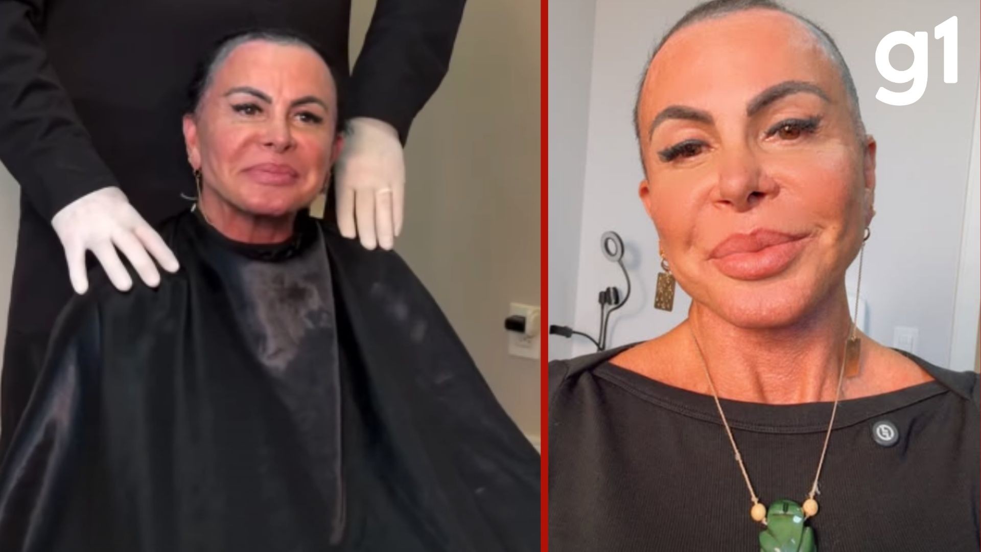 Crostas após transplante capilar são normais? Especialista explica após polêmica de cantora Gretchen com médico de MT