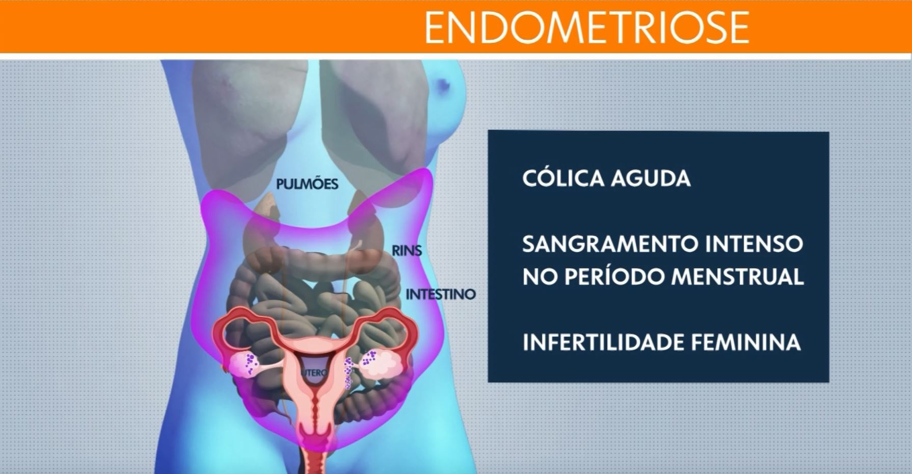Endometriose: Limeira aprova criação de Programa de Proteção a mulher com a doença e prevê cadastro de pacientes; entenda