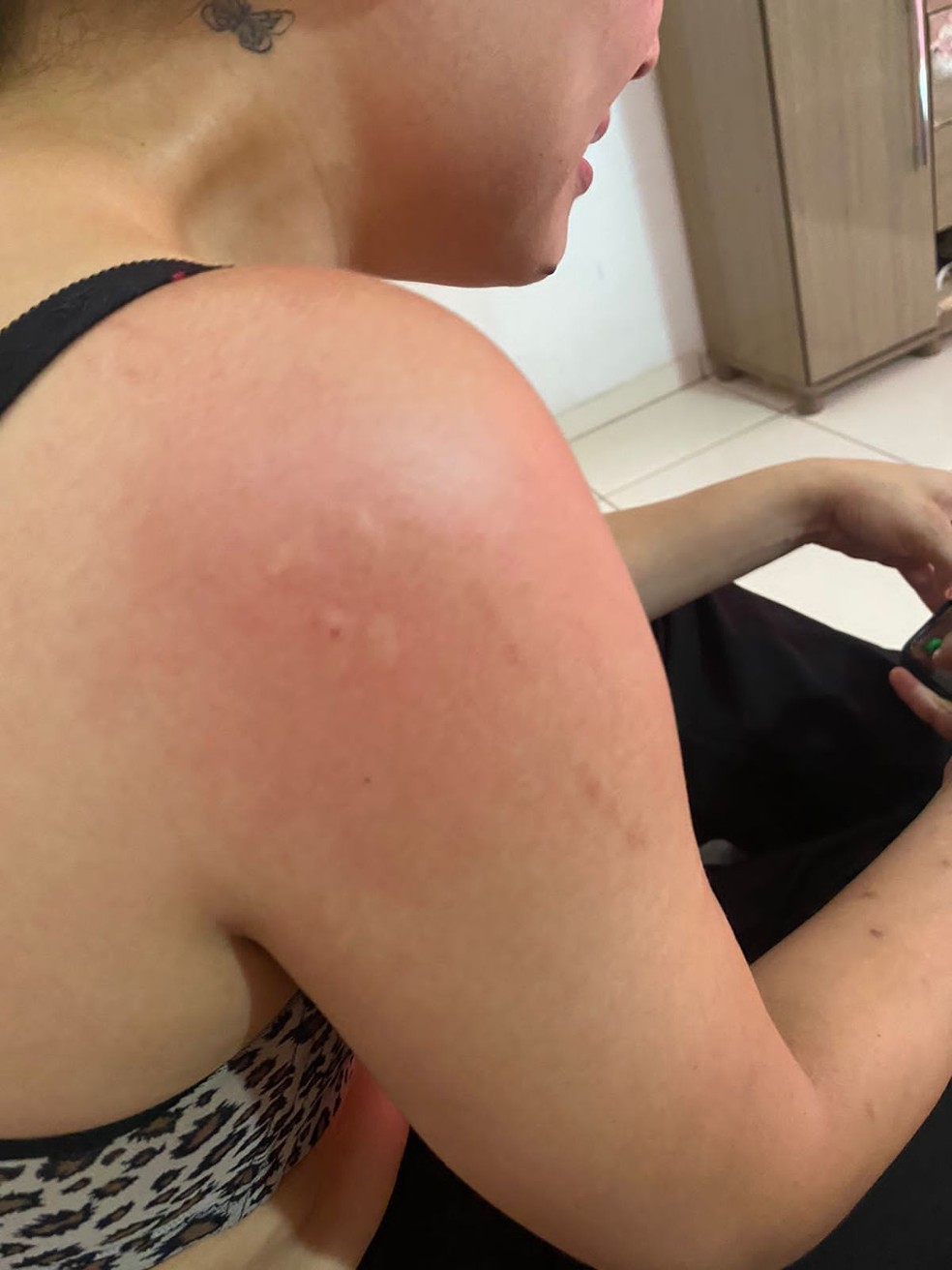 Marca deixada por mordida de médico no ombro de estudante — Foto: Divulgação