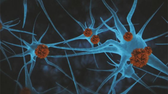 IA pode identificar pacientes com risco de Alzheimer e ajudar a determinar tratamento precoce, diz estudo