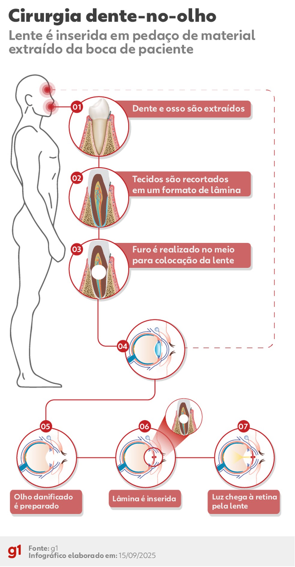 Dente-no-olho: entenda cirurgia que faz pessoas cegas recuperarem a visão |  G1