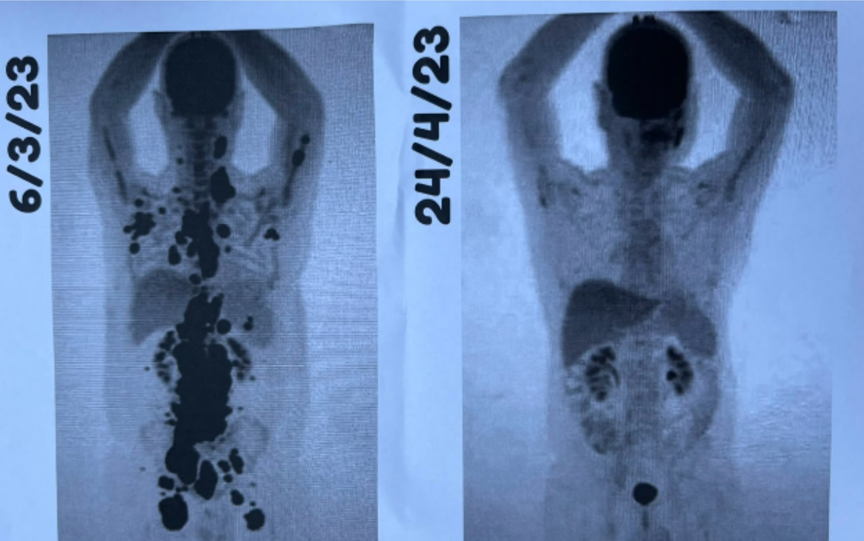 Paciente comemora remissão total do câncer após CAR-T Cell: 'Auge de uma luta de 13 anos'