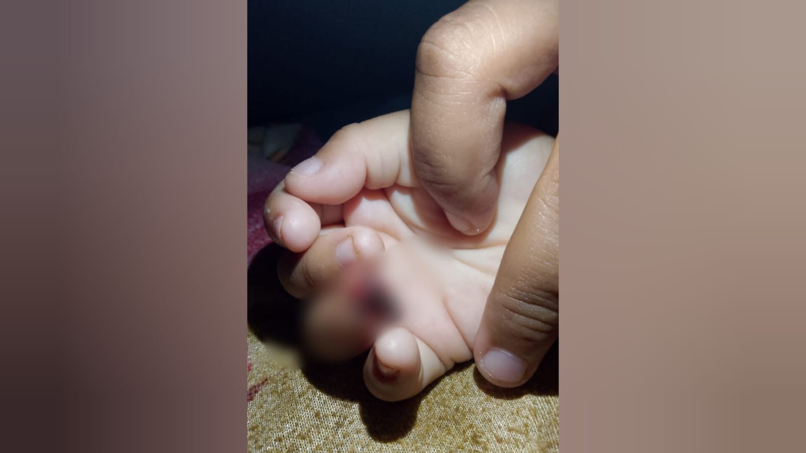 Criança de 4 anos tem parte do dedo amputada em Cemei de Santarém