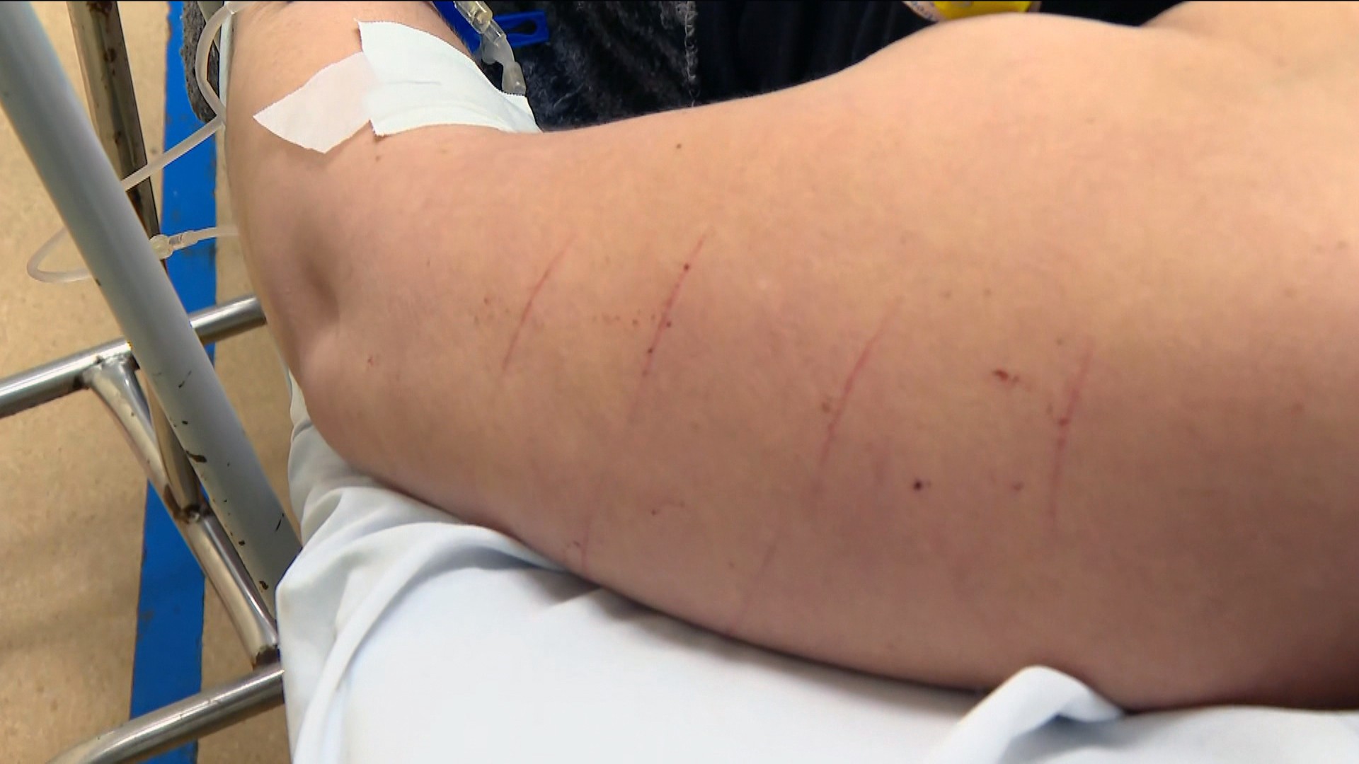 Mulher relata ter sido atacada com tesoura durante assalto em São Gonçalo; um dos golpes foi na barriga