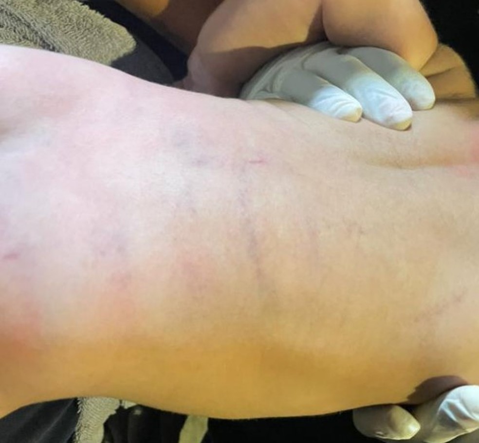 Hematomas pelo corpo. — Foto: Reprodução