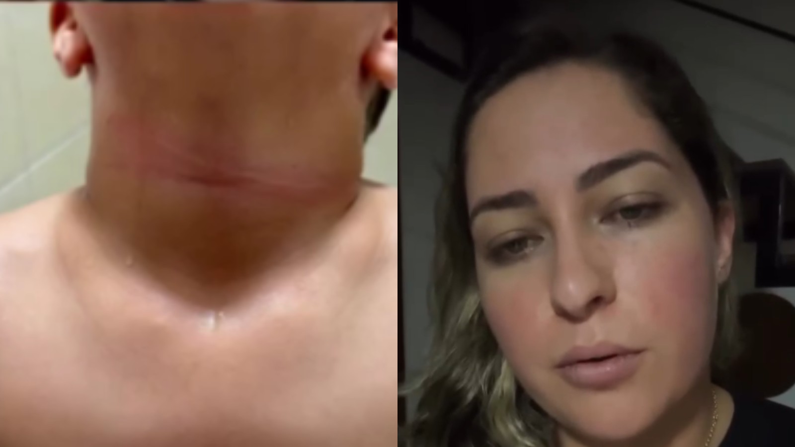 Vídeo: Mãe denuncia que filho de 4 anos teve o pescoço cortado por linha de pipa com cerol: 
