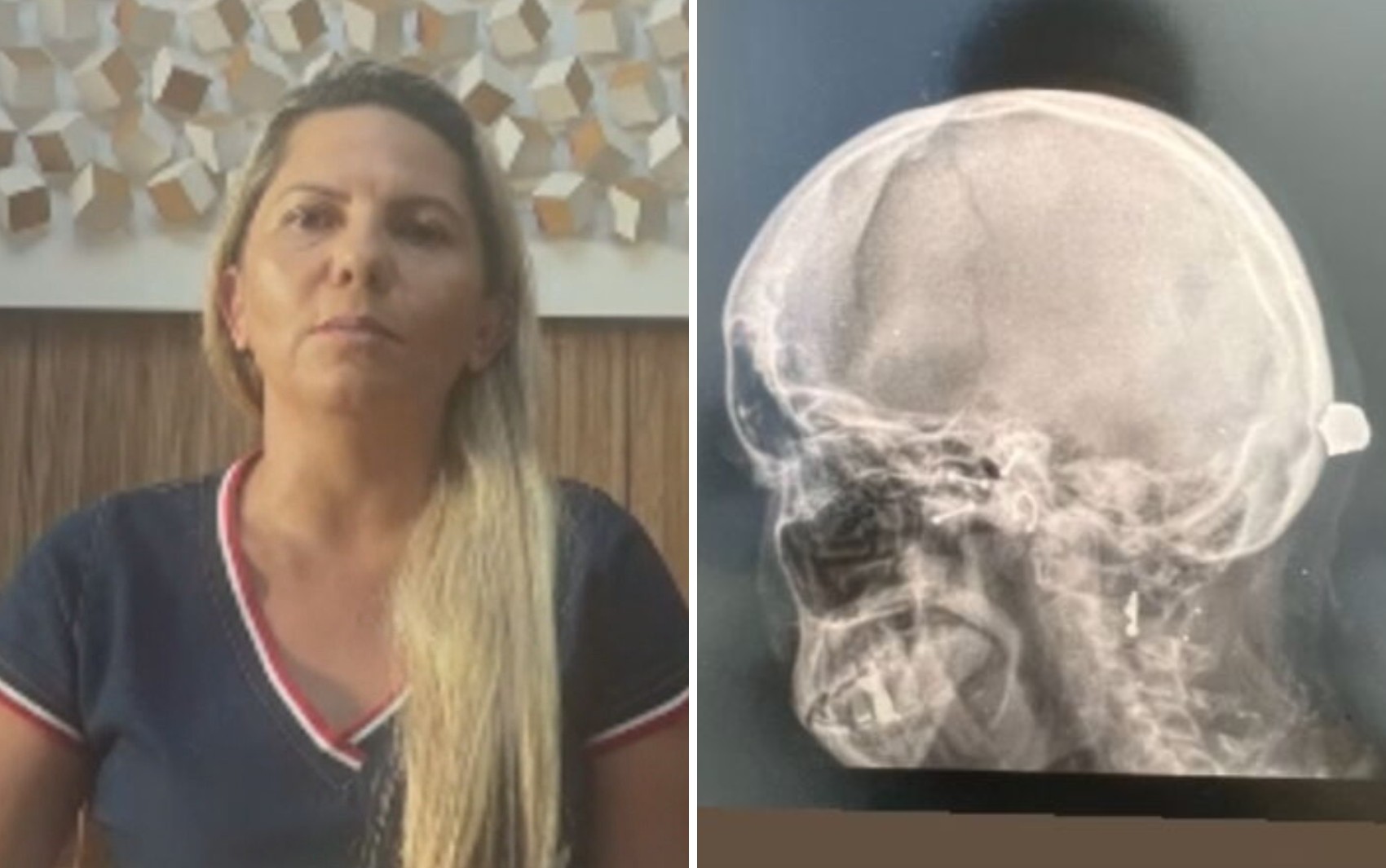 Empresária baleada na cabeça durante briga de trânsito conseguiu colocar endereço do hospital no GPS após ser atingida: 'Milagre'