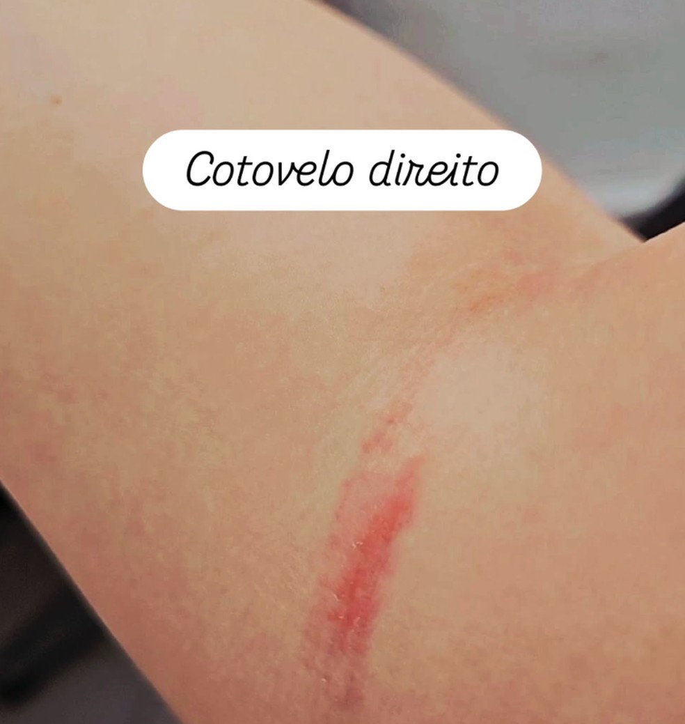 Advogada brasileira mostra hematomas no cotovelo após afirmar ter sido agredido pela polícia no aeroporto de Porto — Foto: Instagram/Reprodução