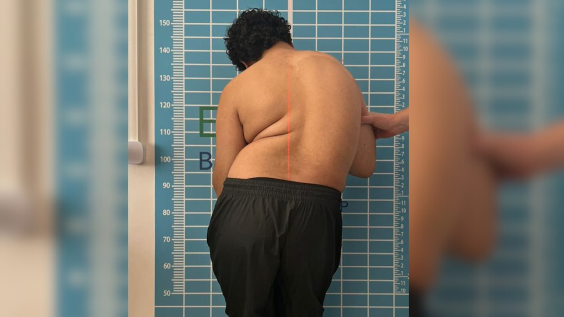 Adolescente com síndrome rara sofre com coluna em 'S' e família busca ajuda: 'Anda e cai para o lado', diz mãe
