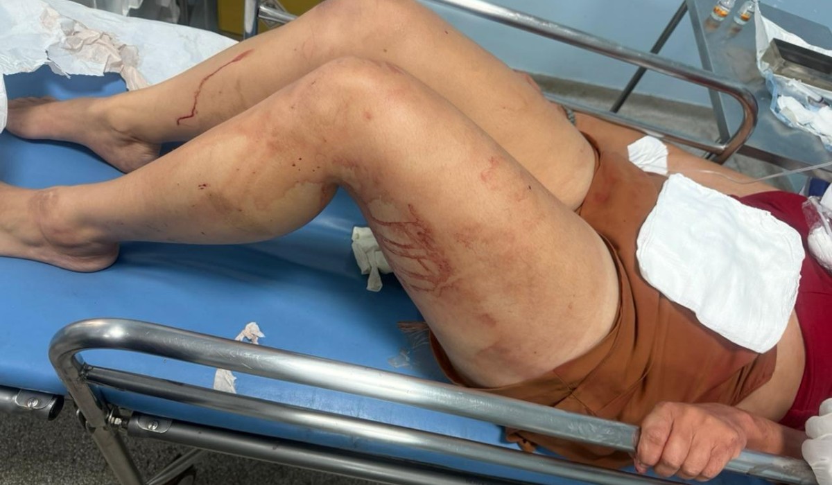 Violência contra mulher: homem agride companheira na cabeça e é preso em hospital de Sumaré