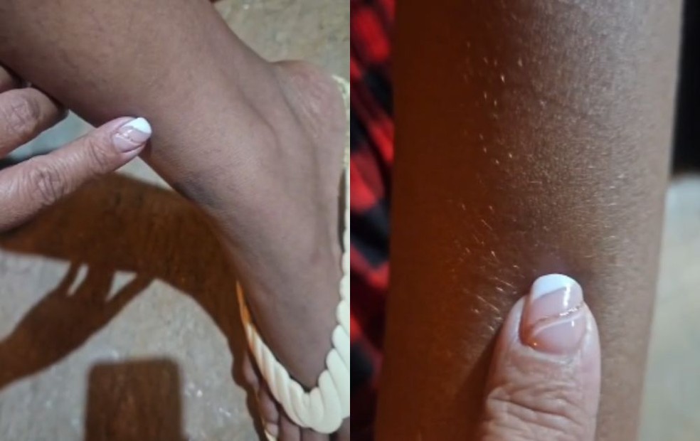 Marcas de agressão a mulher surda, vítima de estupro por homem que invadiu sua casa, em Potirendaba (SP), na noite de terça-feira (22) — Foto: Fotos: Arquivo pessoal