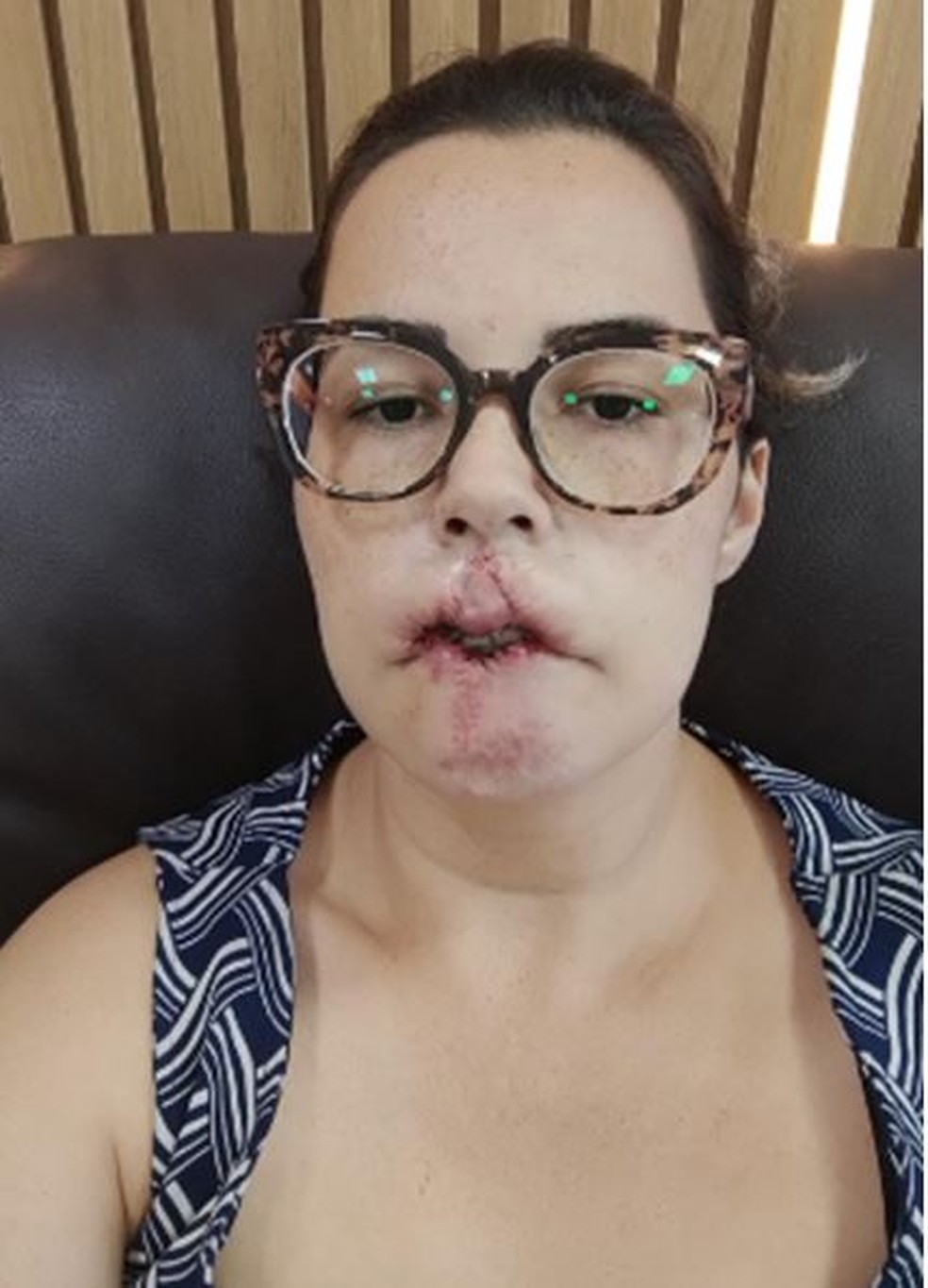 Influenciadora Mariana Michelini após a primeira cirurgia de reconstrução do lábio, que foi retirado após uso de PMMA — Foto: Arquivo pessoal