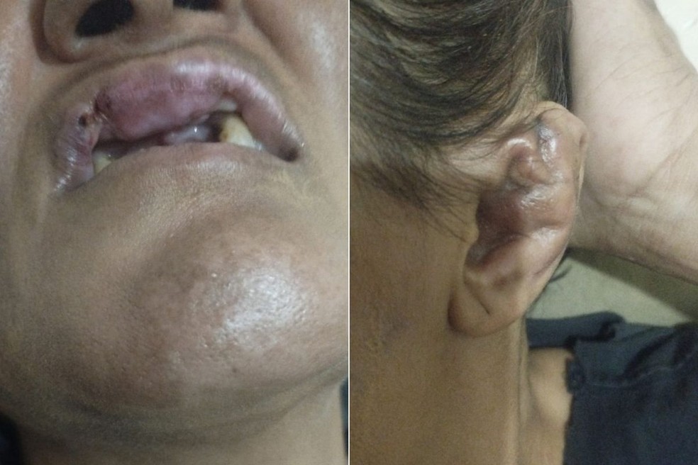 Ferimentos de agressões anteriores sofridas pela mulher em Guarujá, SP — Foto: Arquivo Pessoal