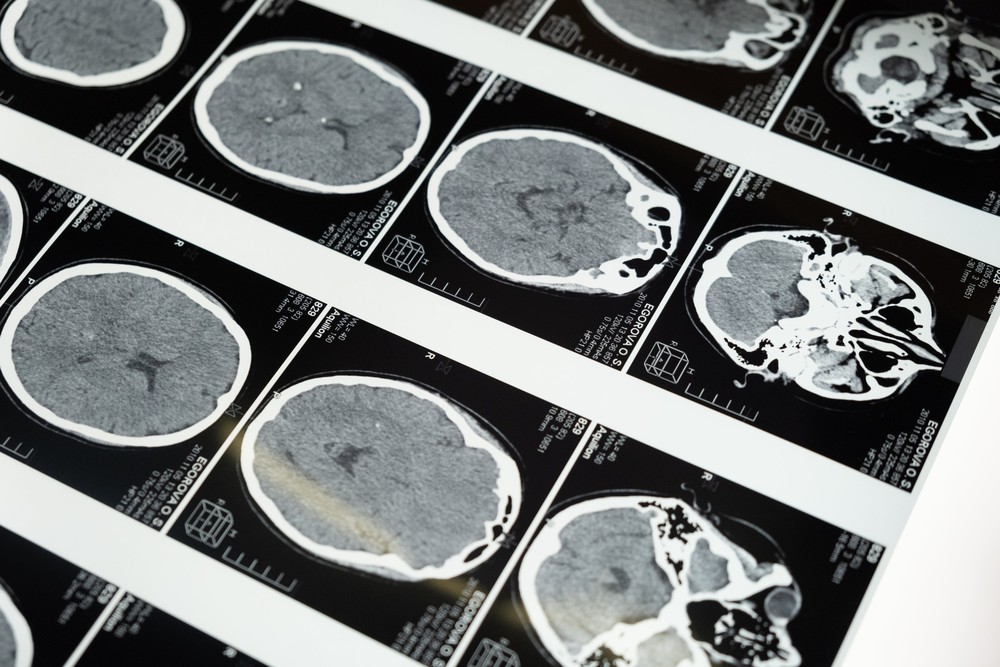 Movimentação do corpo provoca deslocamento do cérebro e auxilia na eliminação de resíduos neuronais