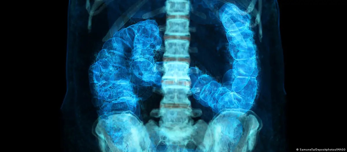 
Entenda os fatores de risco do câncer colorretal, que avança entre jovens