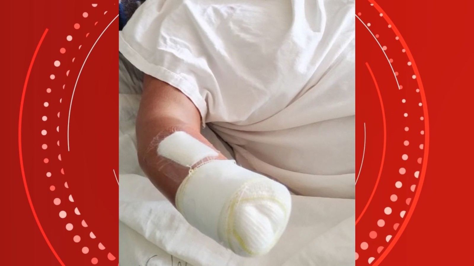 Mulher tem mão amputada ao ser golpeada com foice e facão pelo marido no ES