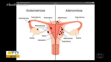 Médico explica a diferença entre endometriose e adenomiose e tira dúvidas