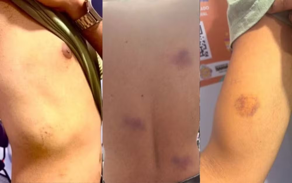 Sete policiais militares são denunciados por agressões no Carnaval de Salvador; vítima passou por cirurgia na mandíbula
