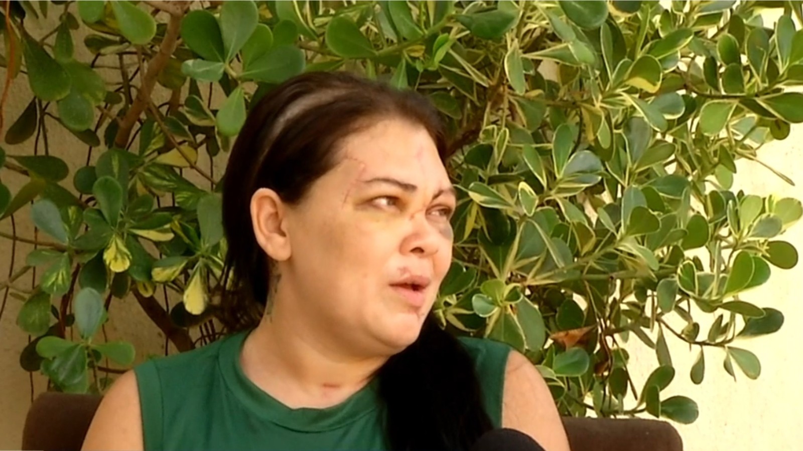 Sobrevivente de tentativa de femicídio deixa hospital com cicatrizes no rosto: 'Não consigo me olhar no espelho'