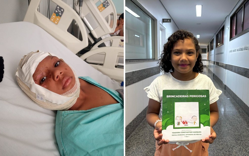 Ysadora se queimou ano passado e escreveu livro para superar trauma, Goiás — Foto: Arquivo pessoal/Emilia Constantino