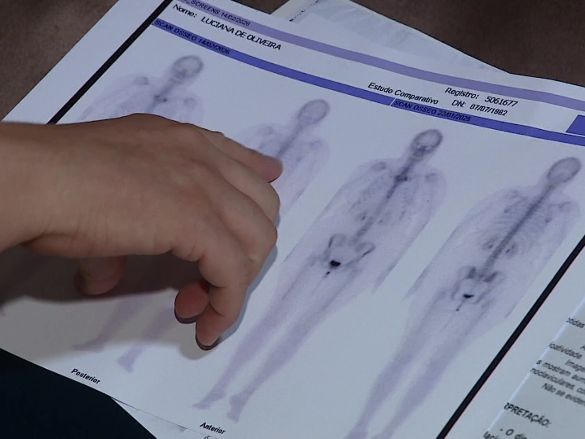 Atendimentos por fibromialgia crescem 33,5% na região de Campinas