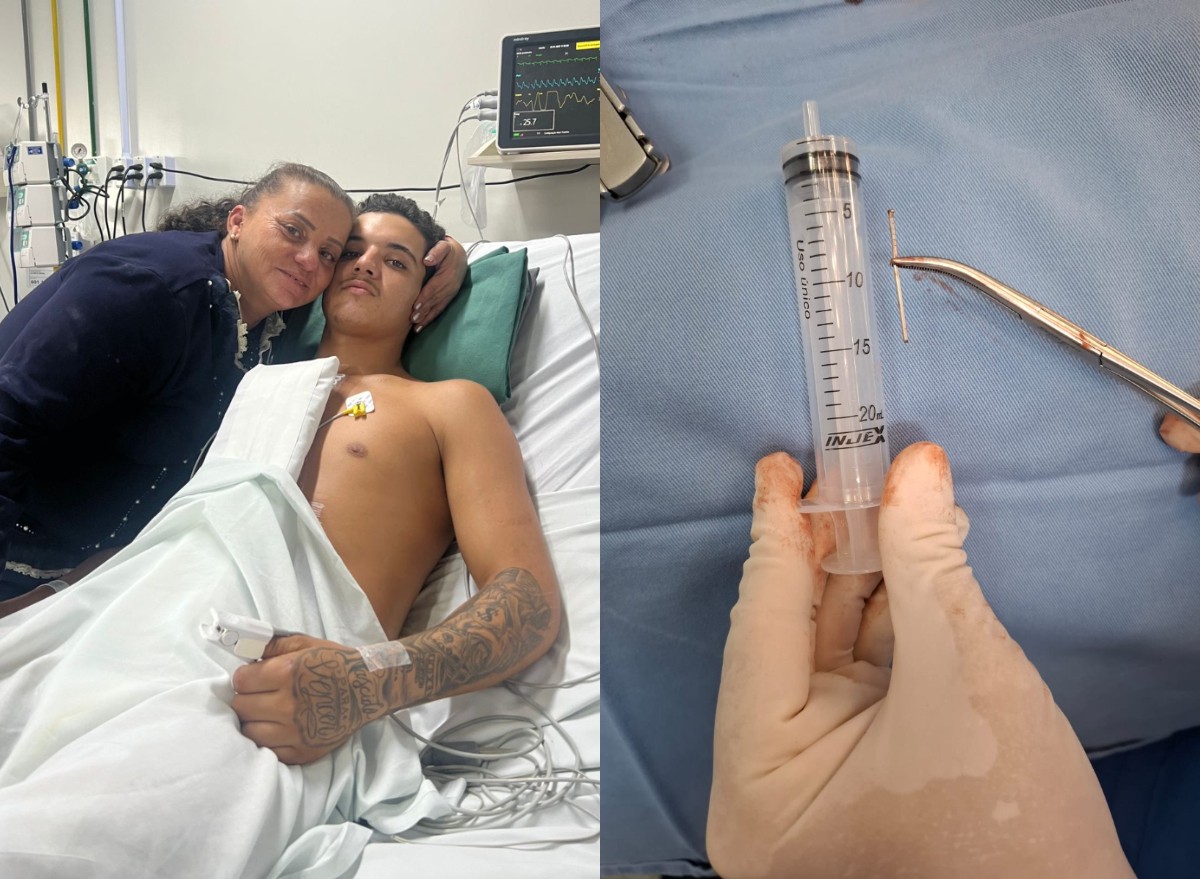Jovem dispara pistola de pregos no próprio coração e sobrevive após cirurgia de emergência