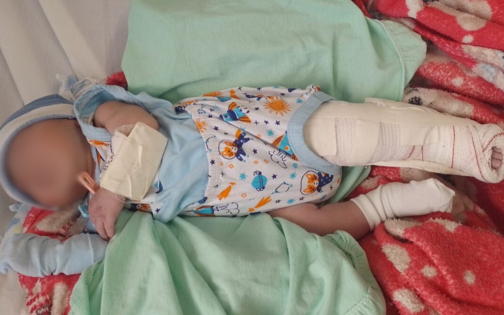 Criança passa bem, apesar da perna quebrada em maternidade da RMS — Foto: Redes sociais