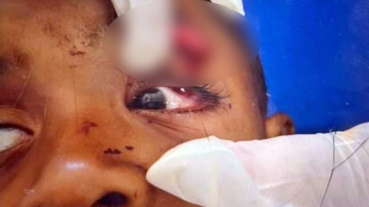 Menino de 6 anos perde visão após operação policial na Mangueira