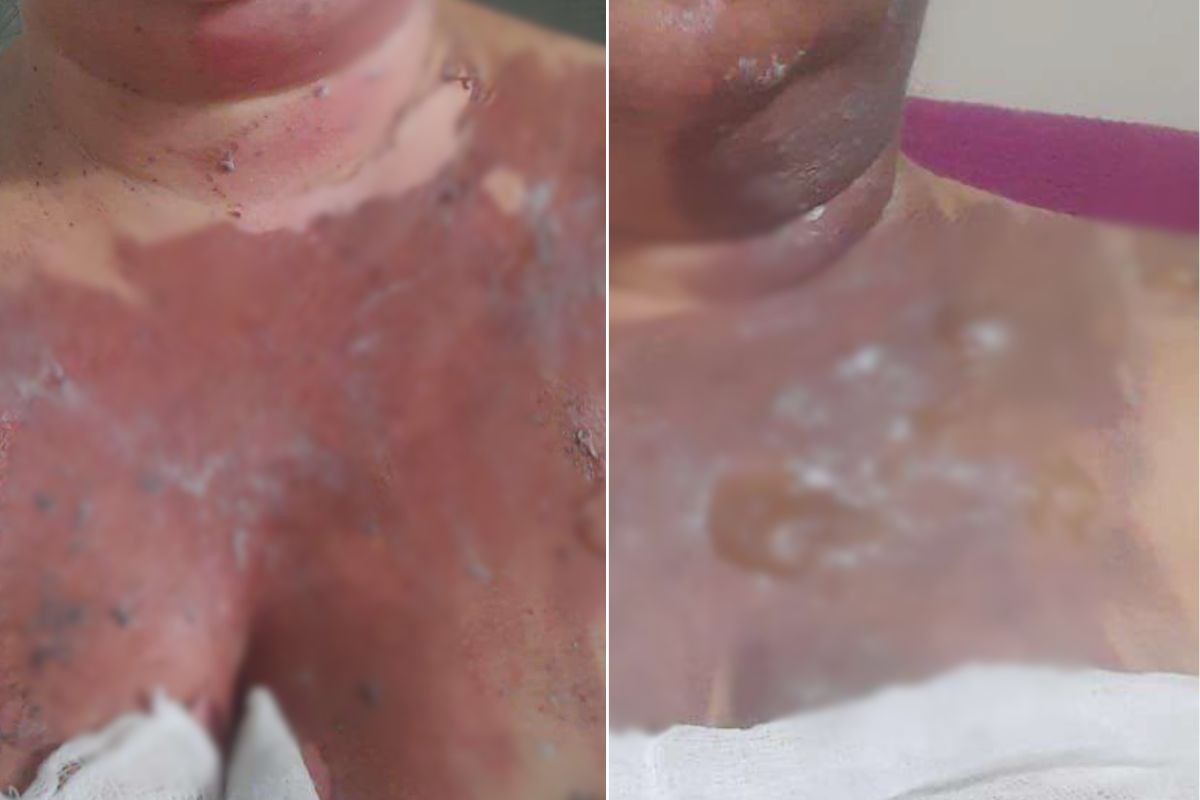 Merendeira sofre queimaduras após panela de pressão explodir em escola; prefeitura é condenada